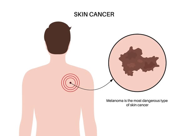 melanoma