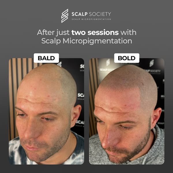 Affordable bald