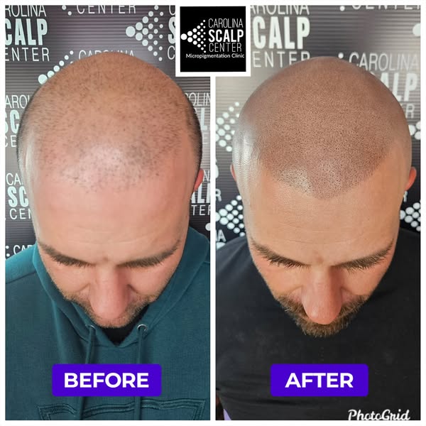 Cost-effective scalp