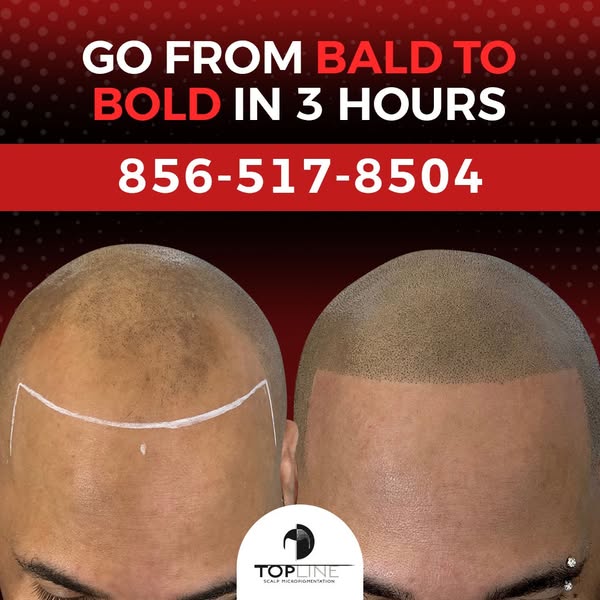 Ultimate bald