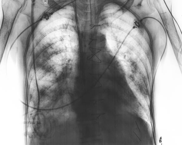 pulmonary