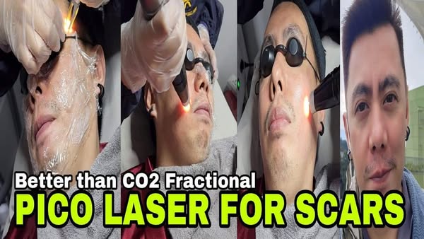Flawless procedure